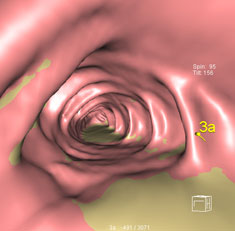 Imatge extreta d’una colonoscòpia virtual Imatge extreta d’una colonoscòpia virtual