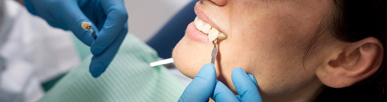 Les "carilles" o pròtesis estètiques dentals és una solució per a tothom? Les "carilles" o pròtesis estètiques dentals és una solució per a tothom?